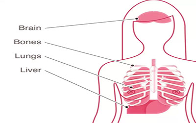 为什么切除了乳房，乳腺癌还会复发？