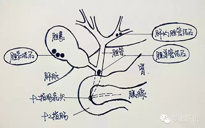 “画”说胆结石那点事，太生动了，秒懂！