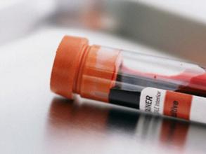 已被证明适用于NSCLC诊断监控，液体活检或开创癌症诊治新模式