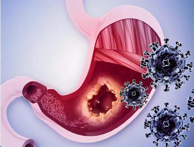 胃癌异质性新发现！上海交通大学发文：提高胃癌免疫治疗效果的新靶点