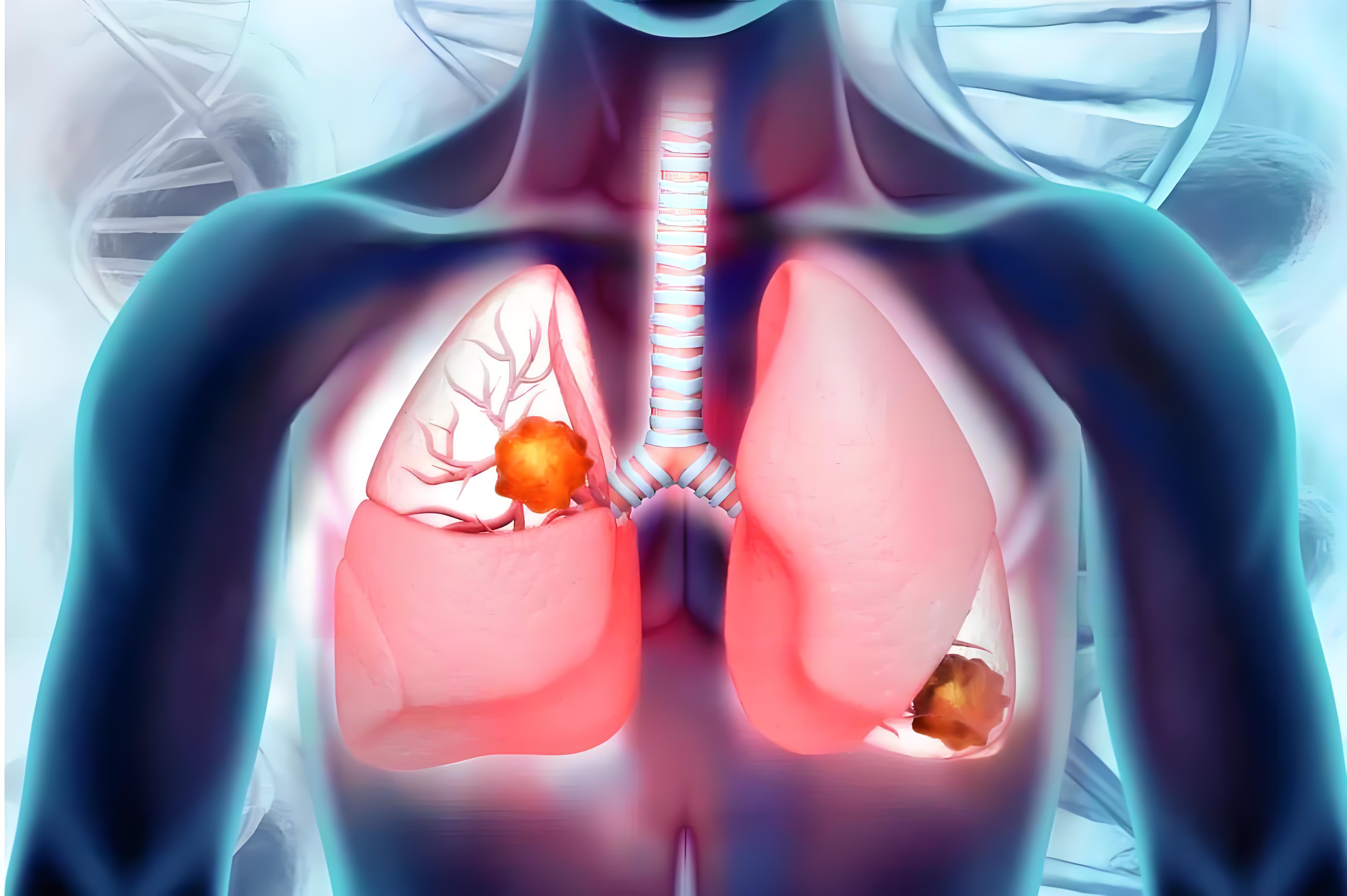 肺癌转移治疗重大进展！浙江大学揭示细胞迁移核心机制并锁定干预靶点