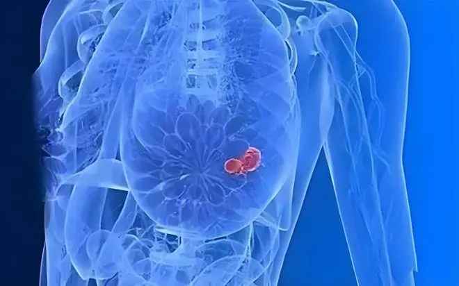 具有临床转化潜力！浙江大学爱丁堡大学联合学院：“最毒乳腺癌”的创新治疗策略