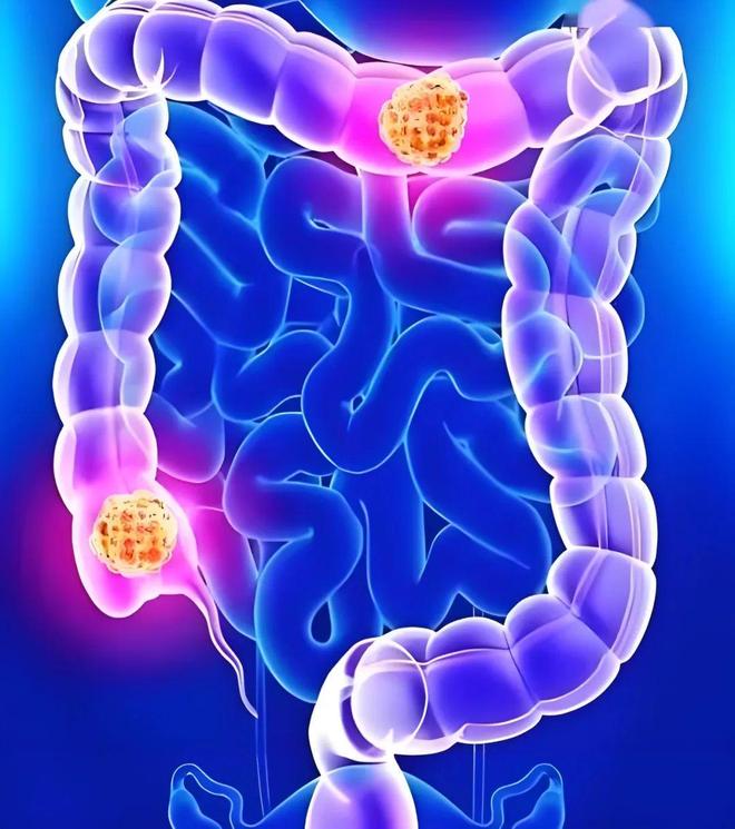 驱动铁死亡抗性及肿瘤免疫！华南理工大学附属第六医院发文：发现结直肠癌治疗新靶点
