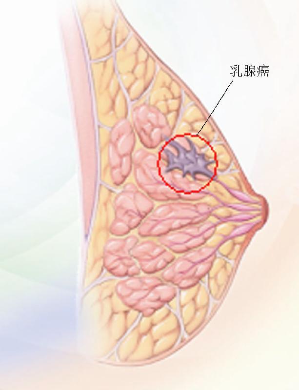 NATURE：CCL2抑制剂的中断会造成乳腺癌的转移